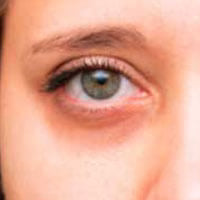 Dark circles