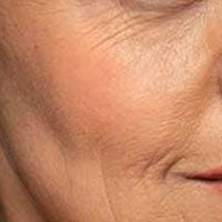 Wrinkles