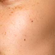 Pigmentation
